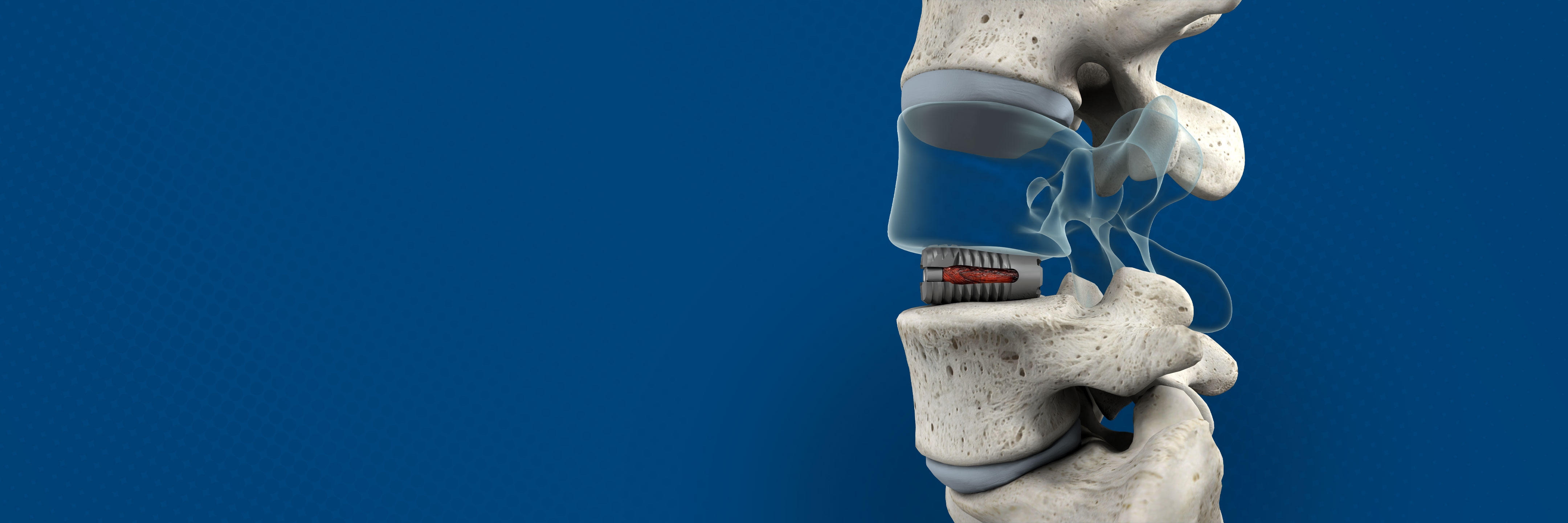 Adam Kremer, . — VariLift®-LX Offers “Neck Fusion on the Back” Adam Kremer, . — VariLift®-LX Offers “Neck Fusion on the Back”